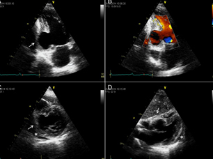 EcocardiogramaTranstoracico
